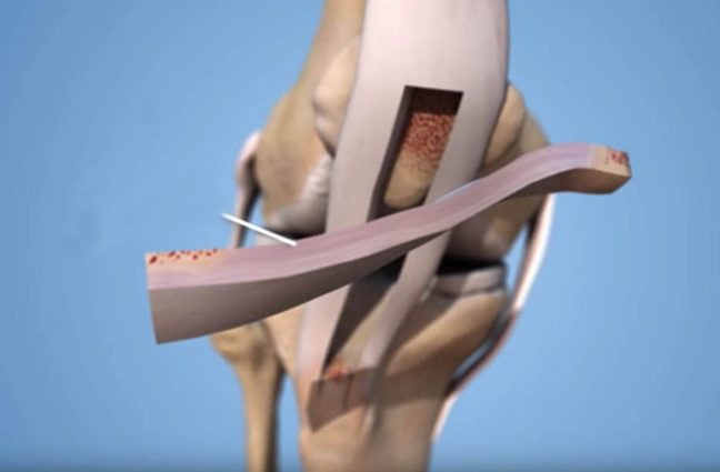 arthroscopy