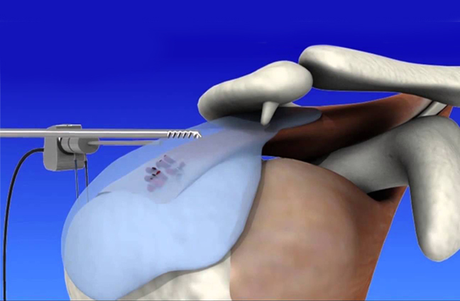 arthroscopy